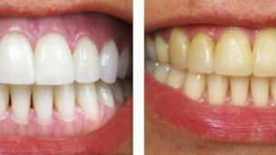 Почему желтеют зубы?