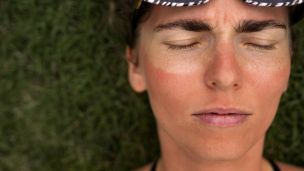 Методы лечения солнечных ожогов