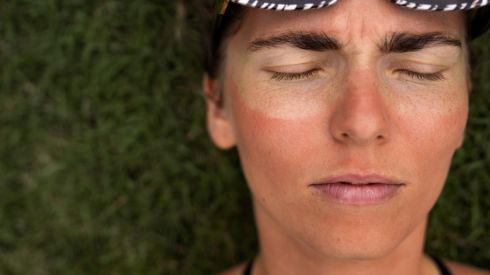 Методы лечения солнечных ожогов