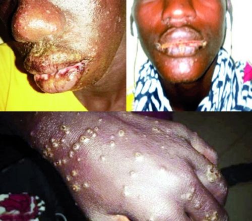 Сыпь - главный симптом неизвестного заболевания