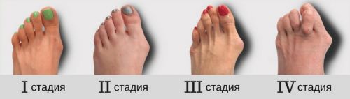 Стадии вальгусной деформации