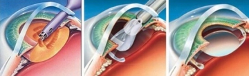 Все преимущества операции факоэмульсификации на катаракте глаза